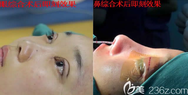 我在北海韓美整形做鼻綜合和眼綜合術(shù)后即刻效果
