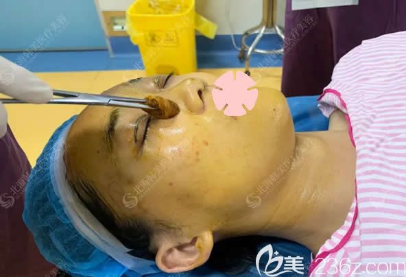 北海韓美整形醫(yī)生在給我做眼鼻整形術(shù)前消毒