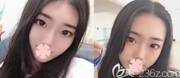 一次性在北海韓美整形做了肋軟骨鼻綜合隆鼻/全切雙眼皮/開內(nèi)眼角,上傳40天恢復(fù)圖