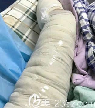 我在北海韓美做大腿環(huán)形吸脂當天照片