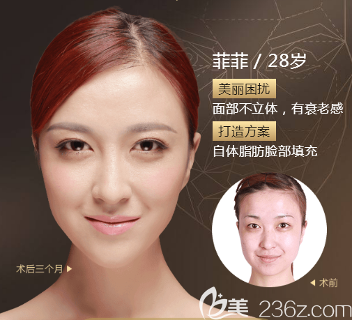 找廣州美萊<!--<i data=20240703-sp></i>-->做的脂肪填充消腫很快 找廣州美萊<!--<i data=20240703-sp></i>-->做的脂肪填充消腫很快