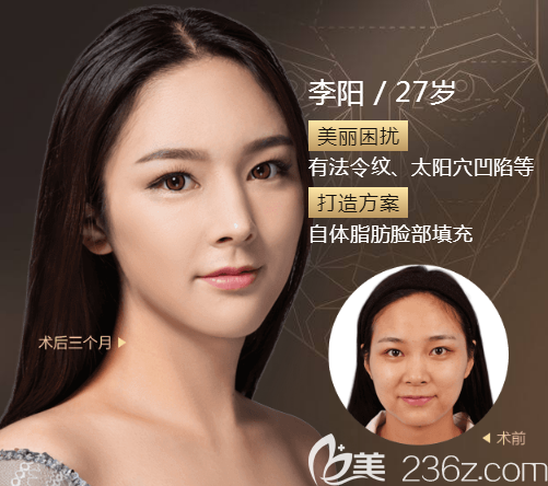 廣州美萊<!--<i data=20240703-sp></i>-->面部脂肪填充案例 廣州美萊<!--<i data=20240703-sp></i>-->面部脂肪填充案例