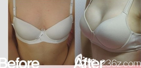 內(nèi)視鏡假體隆胸案例前后效果對比 內(nèi)視鏡假體隆胸案例前后效果對比