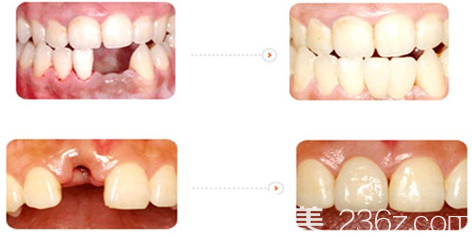 韓國美泊門牙齒種植案例前后效果對比 韓國美泊門牙齒種植案例前后效果對比