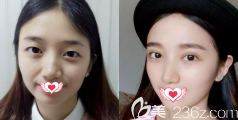 <!--<i data=20240703-sp></i>-->雙眼皮手術(shù)案例 <!--<i data=20240703-sp></i>-->雙眼皮手術(shù)案例