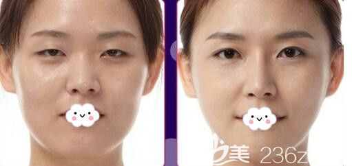 韓國美泊門韓式切開雙眼皮案例前后效果對比 韓國美泊門韓式切開雙眼皮案例前后效果對比