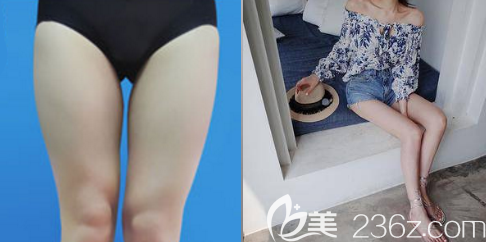 <!--<i data=20240703-sp></i>-->吸脂案例 <!--<i data=20240703-sp></i>-->吸脂案例