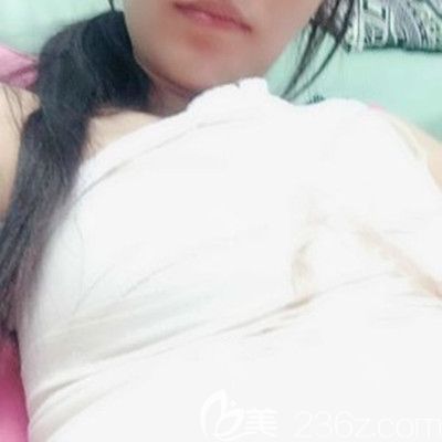 武漢壹加壹付俊俐醫(yī)生曼托假體隆胸術后7天展示圖