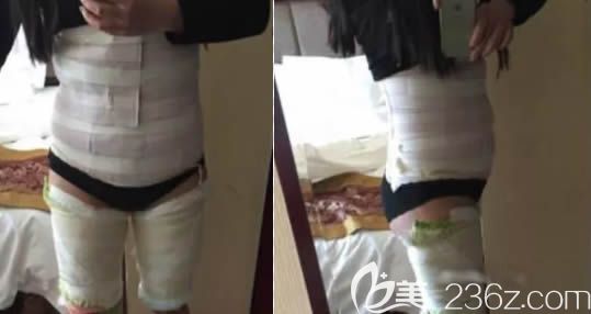 次做完腰腹吸脂后的照片