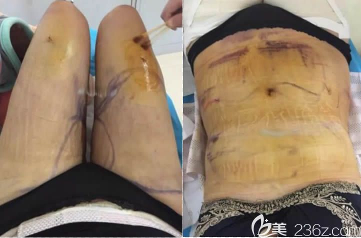 第二次吸脂后拆掉紗布后的留存照