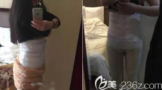 做完腰腹和大腿吸脂2個(gè)月后的效果