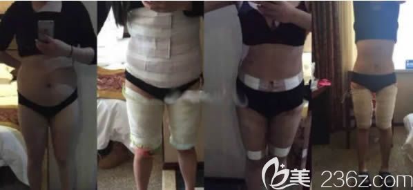 做吸脂前和第1、6個(gè)月的變化過程圖