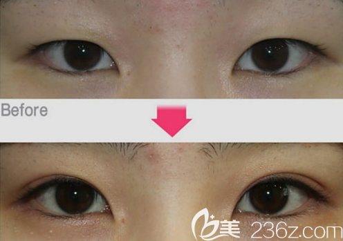韓國美泊門李在承切開雙眼皮案例效果對比圖 韓國美泊門李在承切開雙眼皮案例效果對比圖