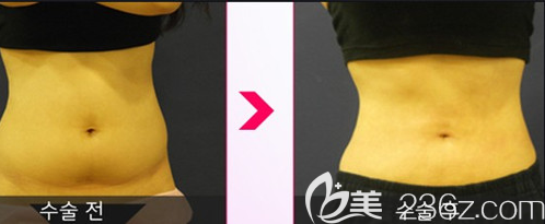 韓國美泊門李在承腰腹吸脂案例前后效果對比圖 韓國美泊門李在承腰腹吸脂案例前后效果對比圖