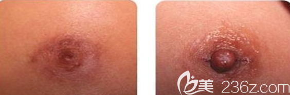 韓國美泊門金尚范乳頭內陷矯正案例前后效果對比圖 韓國美泊門金尚范乳頭內陷矯正案例前后效果對比圖
