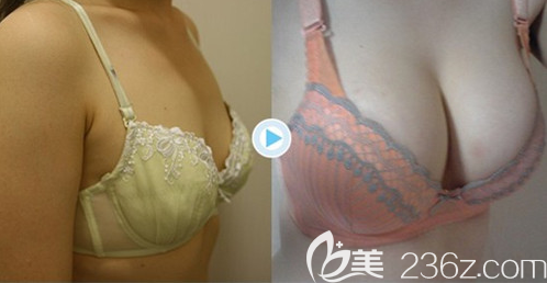 韓國美泊門金尚范自體脂肪豐胸案例效果對比圖 韓國美泊門金尚范自體脂肪豐胸案例效果對比圖