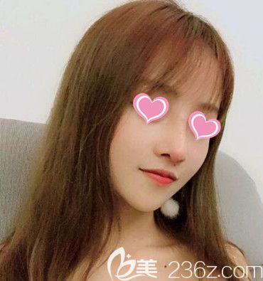 做鼻綜合整形術(shù)后60天時(shí)恢復(fù)效果 做鼻綜合整形術(shù)后60天時(shí)恢復(fù)效果