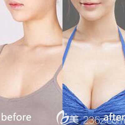 許田海醫(yī)生隆胸前后對比照 許田海醫(yī)生隆胸前后對比照