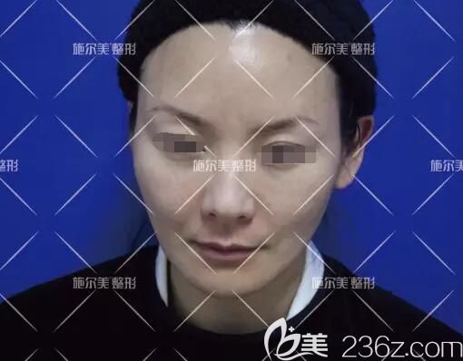 術(shù)前面診面部松弛下垂皺紋明顯