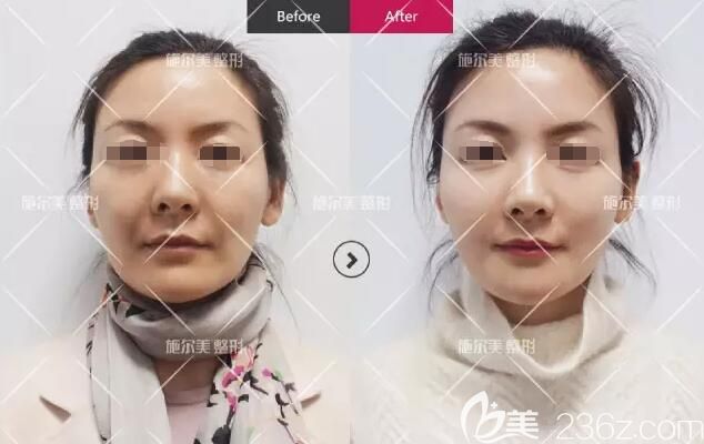 在常州施爾美做完線雕術(shù)前術(shù)后對(duì)比效果