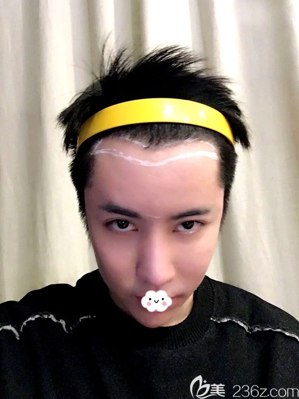 韓國(guó)凱倫秀整形醫(yī)院額頭縮小術(shù)前設(shè)計(jì) 韓國(guó)凱倫秀整形醫(yī)院額頭縮小術(shù)前設(shè)計(jì)