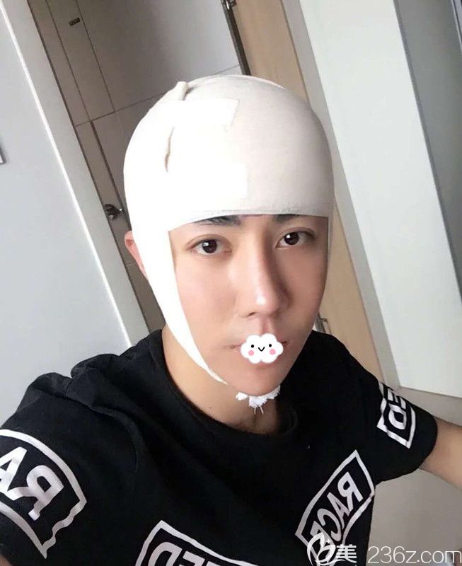 不想做植發(fā)到韓國(guó)凱倫秀做額頭縮小術(shù)后即刻照片 不想做植發(fā)到韓國(guó)凱倫秀做額頭縮小術(shù)后即刻照片