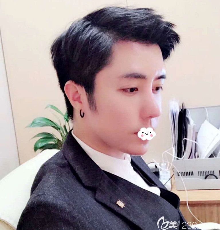 不做發(fā)際線種植到韓國(guó)凱倫秀做額頭縮小術(shù)后半年恢復(fù)效果圖 不做發(fā)際線種植到韓國(guó)凱倫秀做額頭縮小術(shù)后半年恢復(fù)效果圖