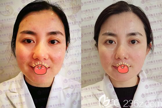 紹興維美整形<!--<i data=20240703-sp></i>-->面部線雕案例