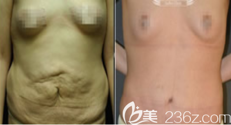 韓國(guó)德社羅伊消除妊娠紋圖片前后效果對(duì)比 韓國(guó)德社羅伊消除妊娠紋圖片前后效果對(duì)比
