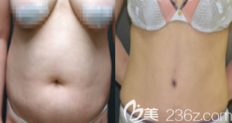 韓國(guó)德社羅伊徐云泳吸脂真人案例 韓國(guó)德社羅伊徐云泳吸脂真人案例