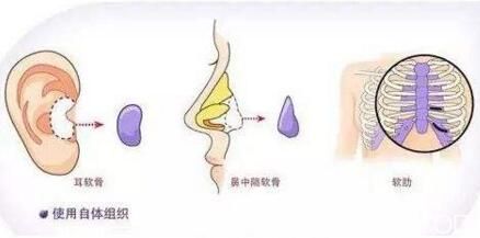 自體軟骨隆鼻材料