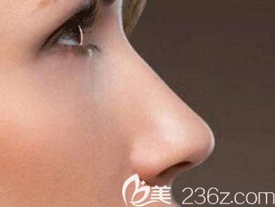 隆鼻假體需要10年要更換一次？