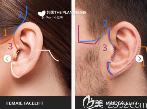 韓國The Plan整形外科醫(yī)院根據男女不同的輪廓結構定制手術方法 韓國The Plan整形外科醫(yī)院根據男女不同的輪廓結構定制手術方法