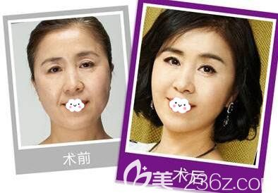 韓版案例前后效果對比圖 韓版案例前后效果對比圖