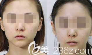 咬肌切除案例 咬肌切除案例