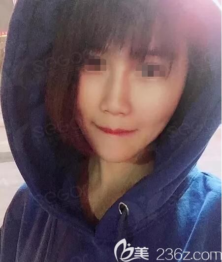 到常州曙光做項(xiàng)目納米脂肪全面部精雕，術(shù)后從喪氣臉到少女顏皮膚也變好了