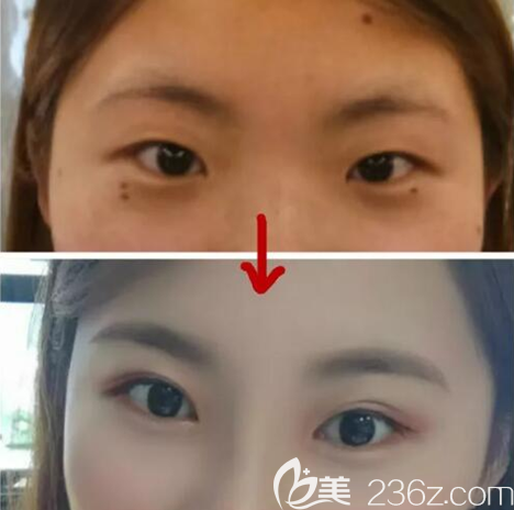 南充華美名媛雙眼皮術(shù)前術(shù)后對比