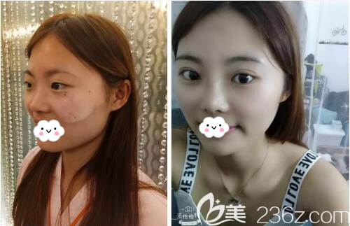 <!--<i data=20240703-sp></i>-->華美名媛綜合隆鼻術(shù)前術(shù)后對比