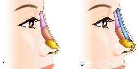 隆鼻取出假體后鼻子跟以前一樣嗎？