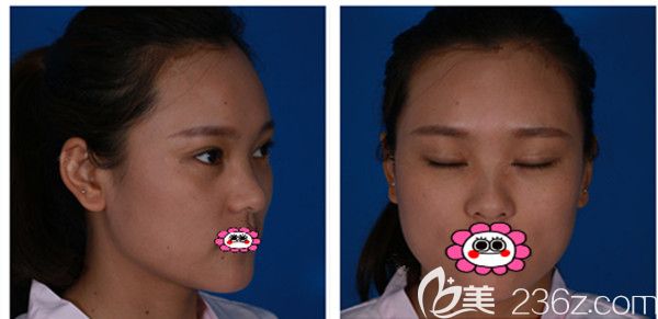 全切雙眼皮1個(gè)月半過程圖