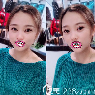 被常德伊麗莎白雙眼皮案例種草了，半年前讓盧開(kāi)銳給我割了雙眼皮