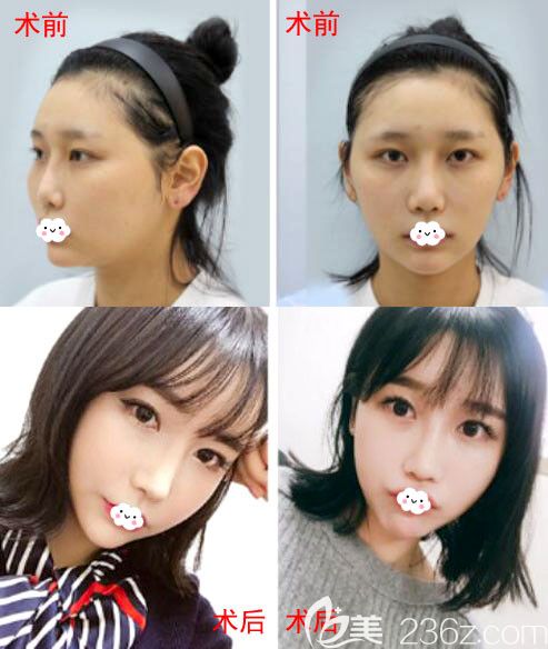 韓國臉本臉骨整形醫(yī)院面部輪廓整形正面?zhèn)让媲昂笮Ч麑Ρ葓D 韓國臉本臉骨整形醫(yī)院面部輪廓整形正面?zhèn)让媲昂笮Ч麑Ρ葓D