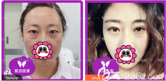 北京紫潔醫(yī)美張金娥醫(yī)生不開刀祛眼袋案例 北京紫潔醫(yī)美張金娥醫(yī)生不開刀祛眼袋案例