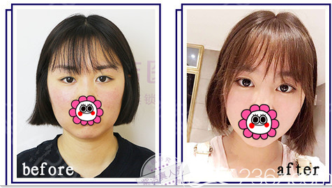 北京紫潔醫(yī)美張金娥醫(yī)生皮下速接雙眼皮案例 北京紫潔醫(yī)美張金娥醫(yī)生皮下速接雙眼皮案例