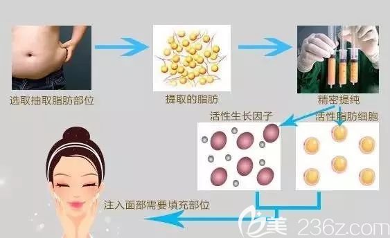 李冬醫(yī)生分享自體脂肪填充原理