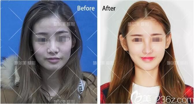 李冬醫(yī)生坐診常州施爾美分享你所嫌棄的脂肪變廢為寶填充在面部變美的故事