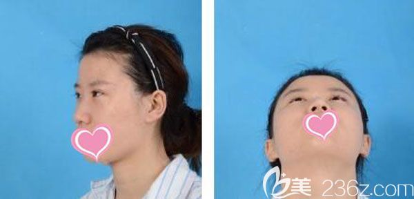 在昆明美伊萊整形隆鼻手術前 在昆明美伊萊整形隆鼻手術前