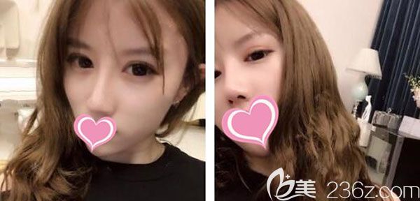 肋軟骨隆鼻手術1個月側面的線條柔和 肋軟骨隆鼻手術1個月側面的線條柔和