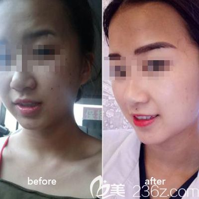 孫華醫(yī)生美膚對(duì)比照 孫華醫(yī)生美膚對(duì)比照