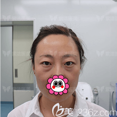 在北京紫潔儷方做不開(kāi)刀祛眼袋前樣子 在北京紫潔儷方做不開(kāi)刀祛眼袋前樣子